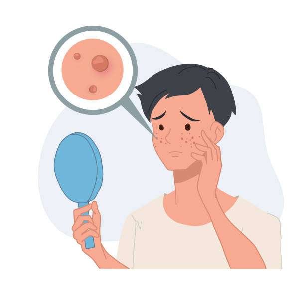 Illustration of acne treatment at Supreme Multispeciality Hospital, offering expert care to manage pimples, blackheads, and whiteheads.